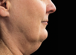I Don’t Like My Double Chin. Can the CoolSculpting Procedure Help Me Lose It?